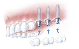 Implant based crowns