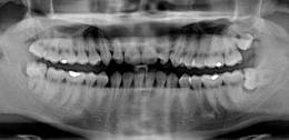 Impacted wisdom teeth - maxillofacial X-ray imaging - Orthopantomography