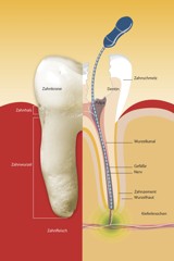 Endodontie Marburg - Schnittbild eines beherdeten Zahnes, in dem ein langes, dünnes Wurzelkanalinstrument steckt