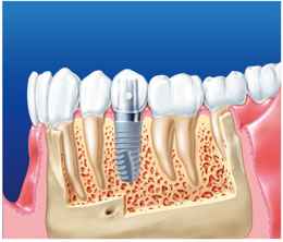 Zahnersatz - Schnittbild einer Implantatgetragenen Krone im Kieferknochen- Frialit®