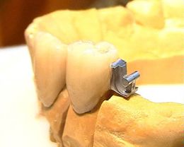 Kombinierter Zahnersatz - Konfektionsgeschiebe an metallkeramisch verblendeter Krone