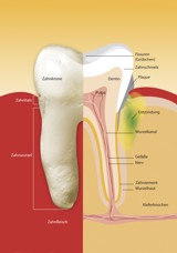 Parodontologie - Schnittbild eines an Parodontitis erkrankten Zahnes und des umgebenden Knochens