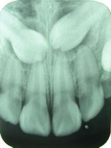 Röntgenbild, welches zwei verlagerte und retinierte obere Eckzähne zeigt