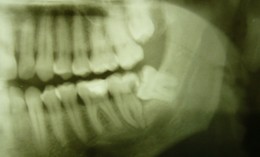 Röntgenbild, welches einen Zahn zeigt, der durch einen Weisheitszahn so kariös wurde, dass er nicht zu retten ist